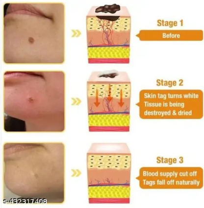 DERMA SMOOTH® SKIN TAG REMOVER PATCH – 72 Patches