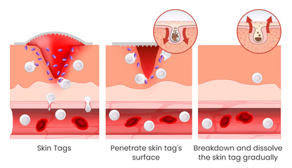 DERMA SMOOTH® SKIN TAG REMOVER PATCH – 72 Patches